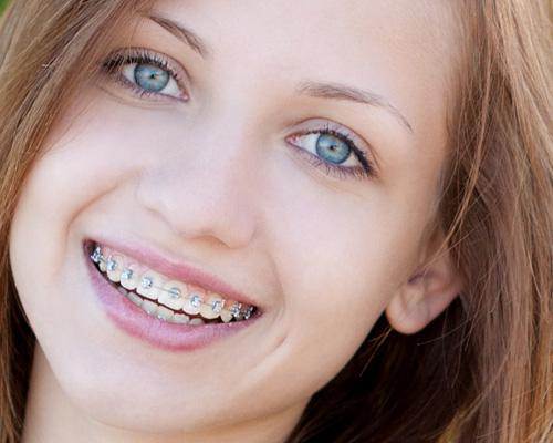 If you imagine metal brackets and wires when someone says braces, you’re in...